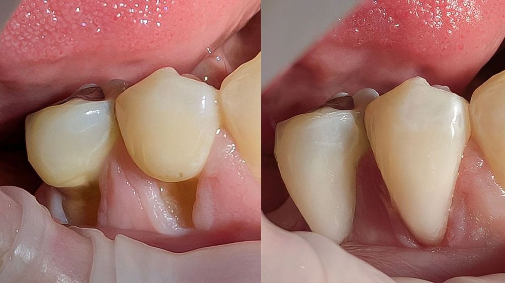 Composite Bonding for Receding Gums Before and After (Case 2)